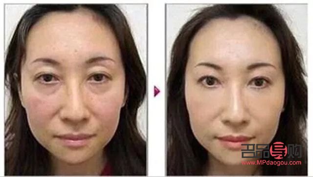 先天性腫眼泡怎么消除圖片(先天性腫眼泡怎么消除圖片大全)