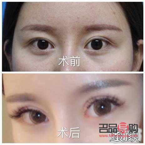 全切雙眼皮和眼綜合區(qū)別大嗎(全切雙眼皮和眼綜合區(qū)別大嗎多少錢)