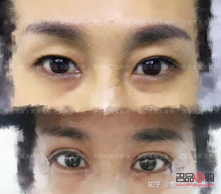 全切雙眼皮和眼綜合區(qū)別大嗎(全切雙眼皮和眼綜合區(qū)別大嗎多少錢)