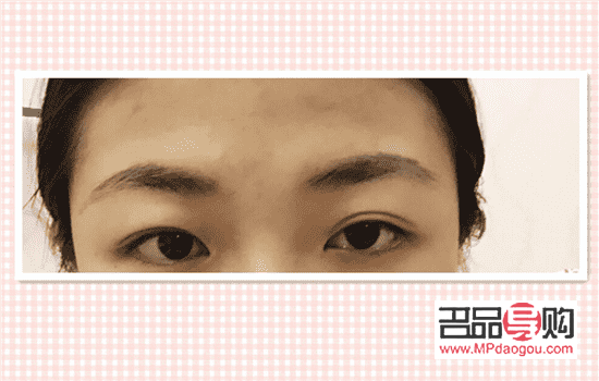 雙眼皮恢復(fù)期照片(雙眼皮恢復(fù)的照片)