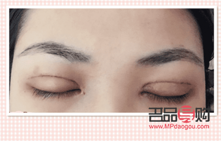 雙眼皮恢復(fù)期照片(雙眼皮恢復(fù)的照片)