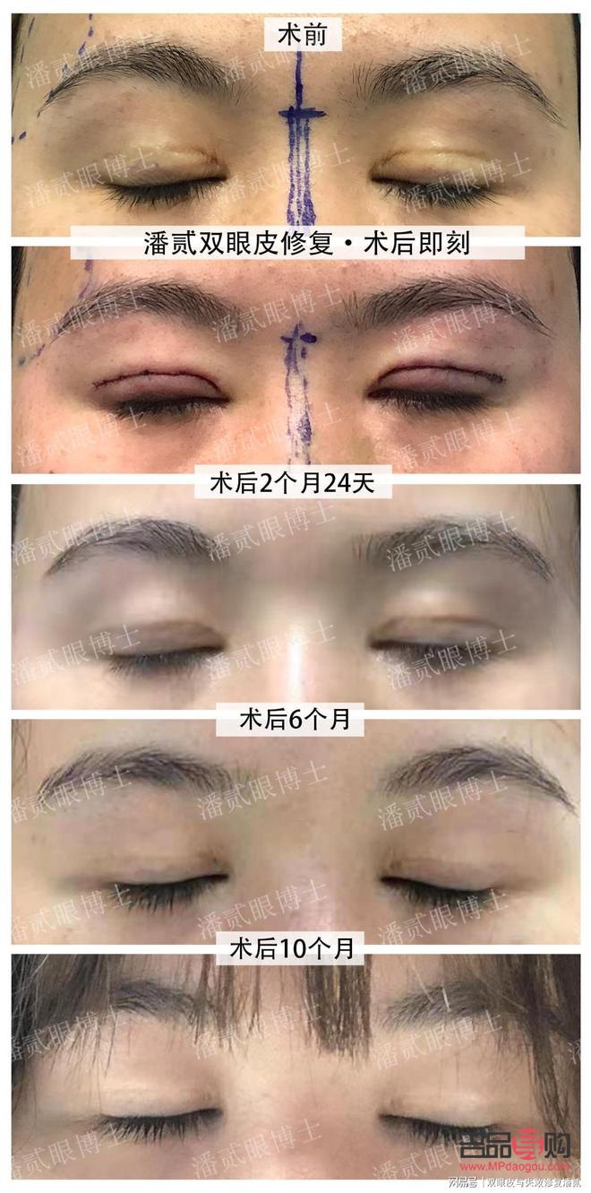 砭石眼部按摩恢復(fù)視力(砭石眼部按摩恢復(fù)視力有效果嗎)