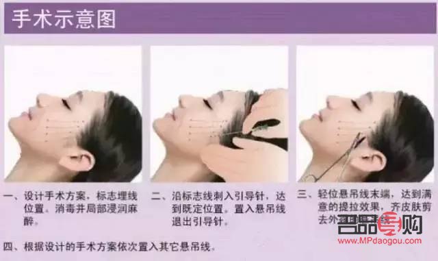 線雕雙眼皮與埋線雙眼皮的區(qū)別詳解