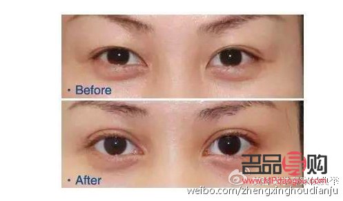 <h1>雙眼皮魅力之謎：外雙與內(nèi)雙邊的獨特組合</h1>