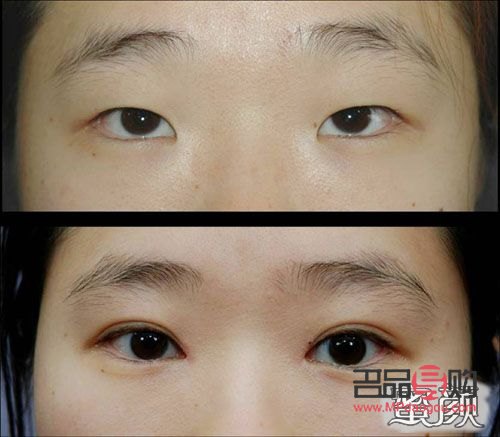 <h1>雙眼皮魅力之謎：外雙與內(nèi)雙邊的獨(dú)特組合</h1>