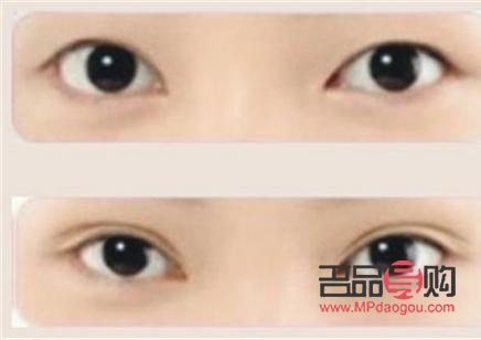 <h3>內(nèi)雙想割雙眼皮，哪種手術(shù)方法更適合？</h3>