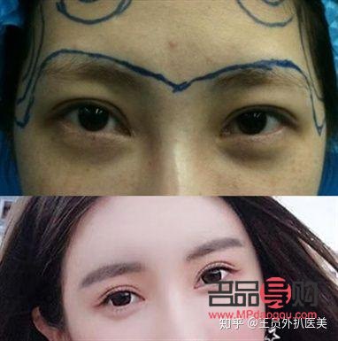 如何應(yīng)對(duì)一個(gè)眼皮單一個(gè)眼皮雙的困擾？