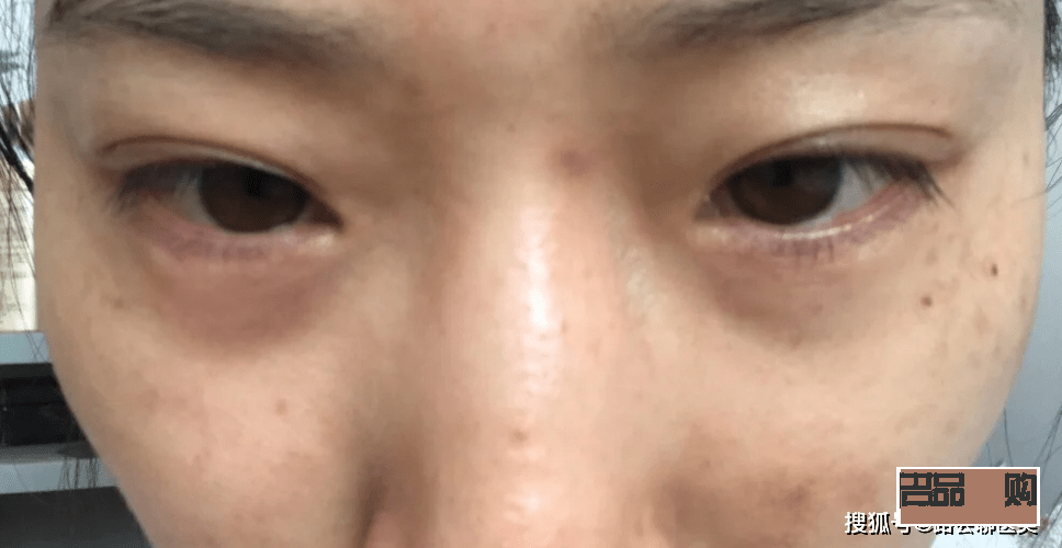 眼睛周圍凹陷怎么恢復(fù)飽滿的方法(眼睛周圍凹陷怎么恢復(fù)飽滿的方法圖片)