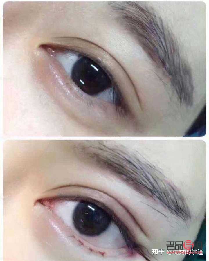 現(xiàn)在流行什么雙眼皮手術(shù)(現(xiàn)在流行什么雙眼皮手術(shù)效果好)