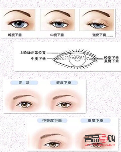 上瞼下垂做雙眼皮可以改變嗎(上瞼下垂做雙眼皮可以改變嗎)