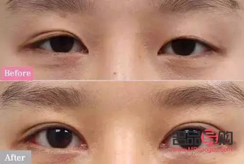 兩個眼皮不一樣怎么回事(兩個眼皮不一樣怎么回事兒)