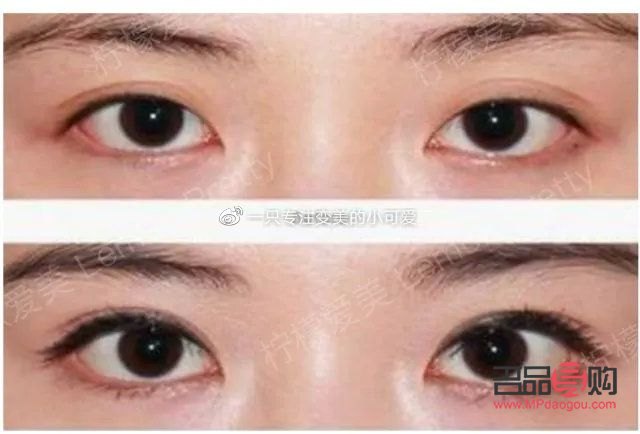 新月型雙眼皮是否顯老氣？圖片解析與探討