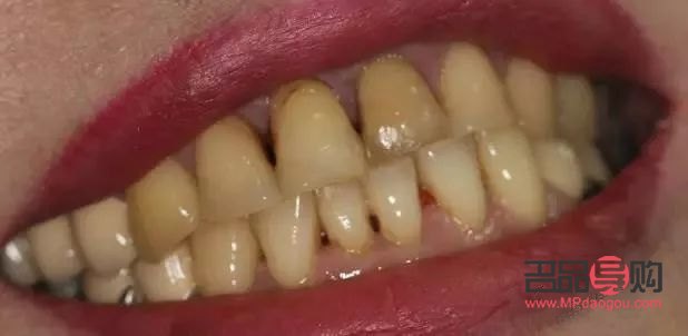 牙尖怎么美容的(牙尖怎么辦有什么小妙招)