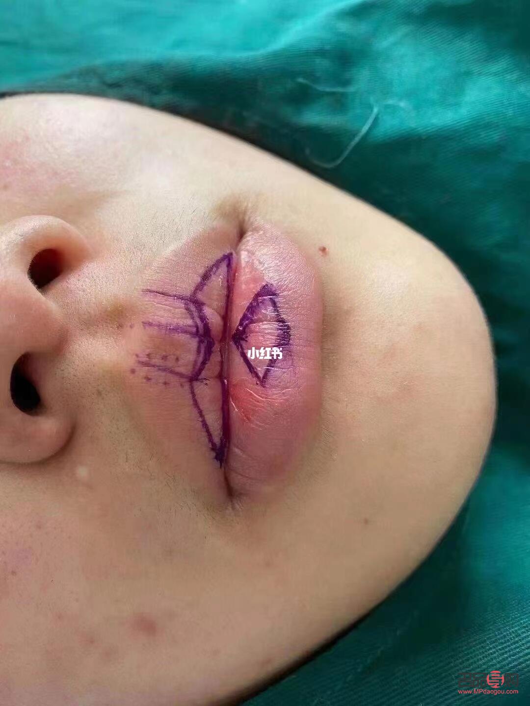 美容可以切嘴唇嗎(美容可以切嘴唇嗎圖片)