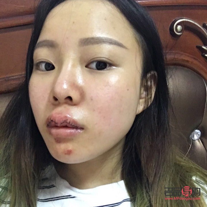 美容可以切嘴唇嗎(美容可以切嘴唇嗎圖片)