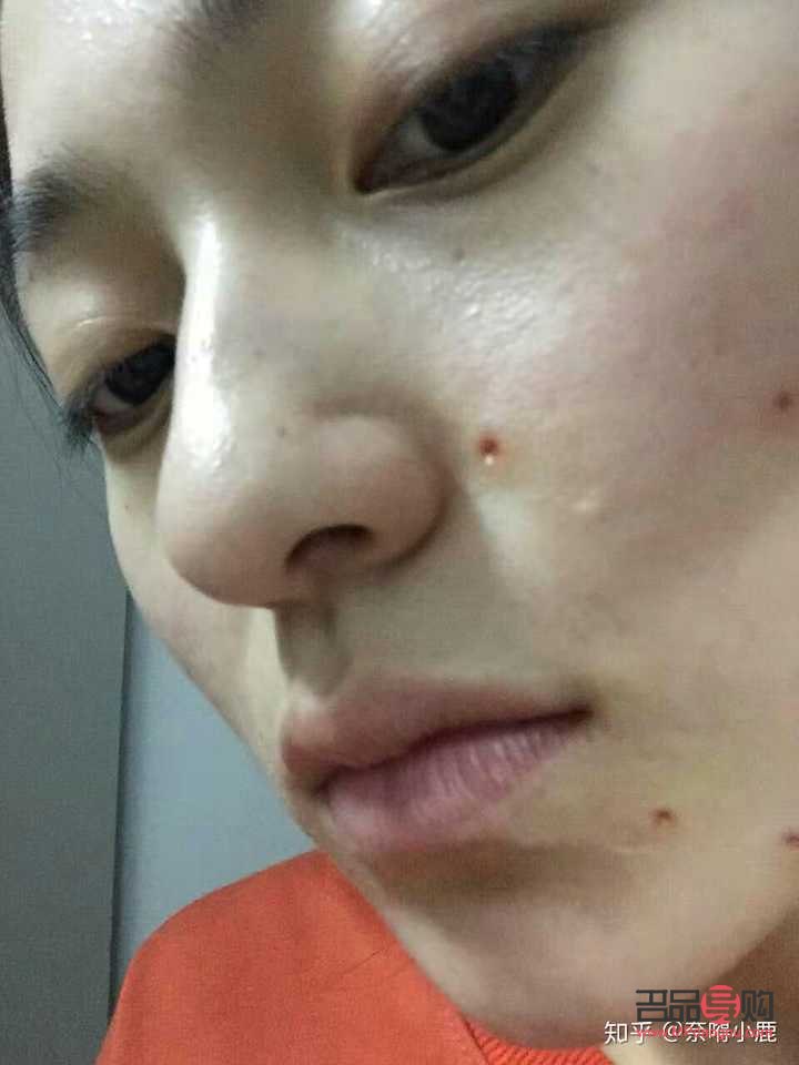 哪家美容點(diǎn)痣(哪家美容點(diǎn)痣比較好)