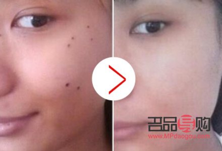 哪家美容點痣(哪家美容點痣比較好)