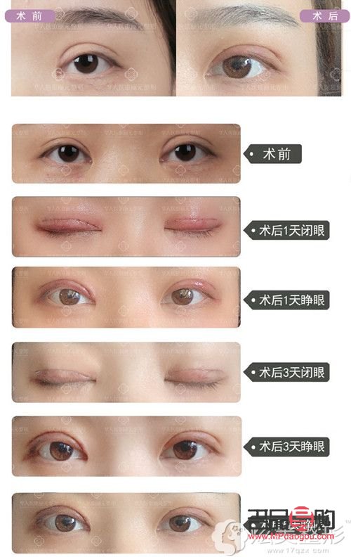 雙眼皮成功的案例有哪些(雙眼皮成功的案例有哪些)