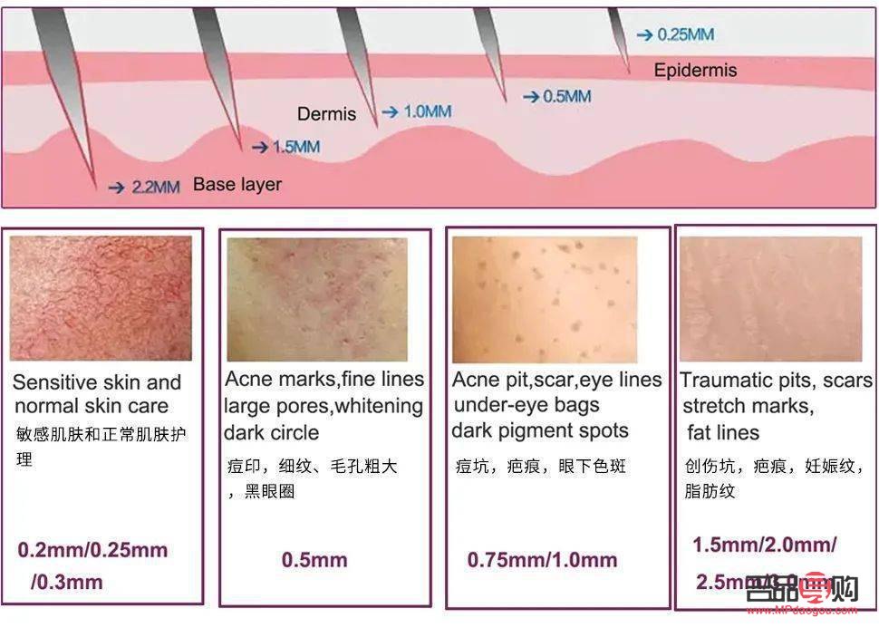 <h3>美容針能否完全去除疤痕？</h3>