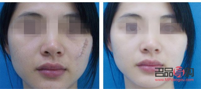 美容針能否完全去除疤痕？