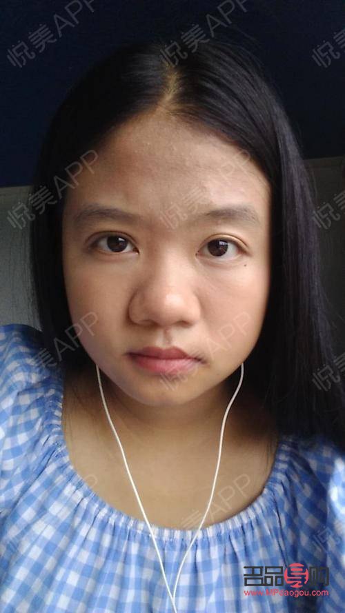 <h3>大小眼手術(shù)可能帶來的后遺癥</h3>