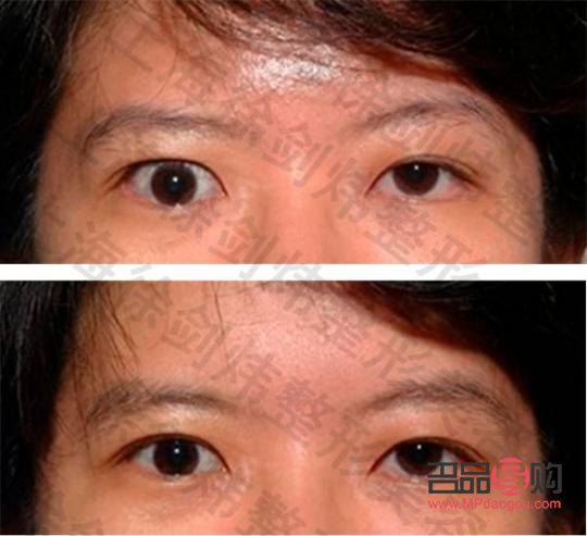 <h3>大小眼手術(shù)可能帶來的后遺癥</h3>