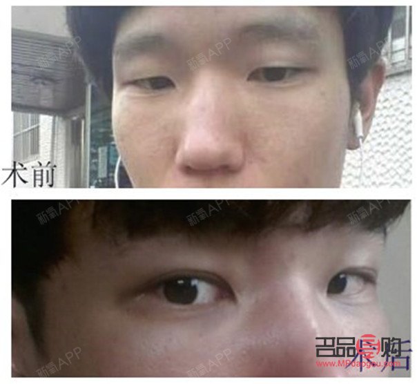 大小眼手術(shù)可能帶來的后遺癥