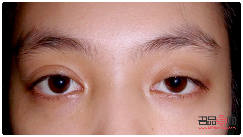 改善近視：針對(duì)一雙一單眼睛的獨(dú)特策略