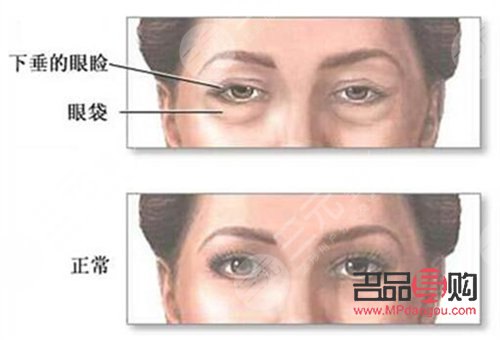 割眼袋有風(fēng)險嗎(割眼袋有風(fēng)險嗎?)