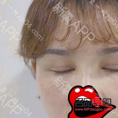 <h3>雙眼皮手術(shù)如何自然不顯假</h3>