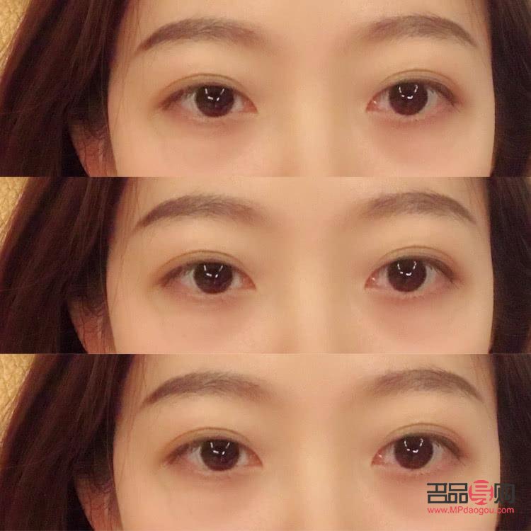 雙眼皮手術(shù)有幾種款式圖片(雙眼皮手術(shù)有幾種款式圖片及價格)