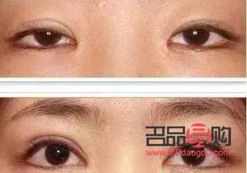 雙眼皮成品圖片真實(shí)展示：魅力雙眼的蛻變之旅