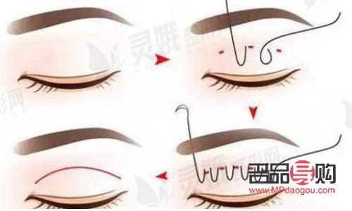 <h3>雙眼皮太寬如何巧妙變窄？專業(yè)技巧大揭秘</h3>