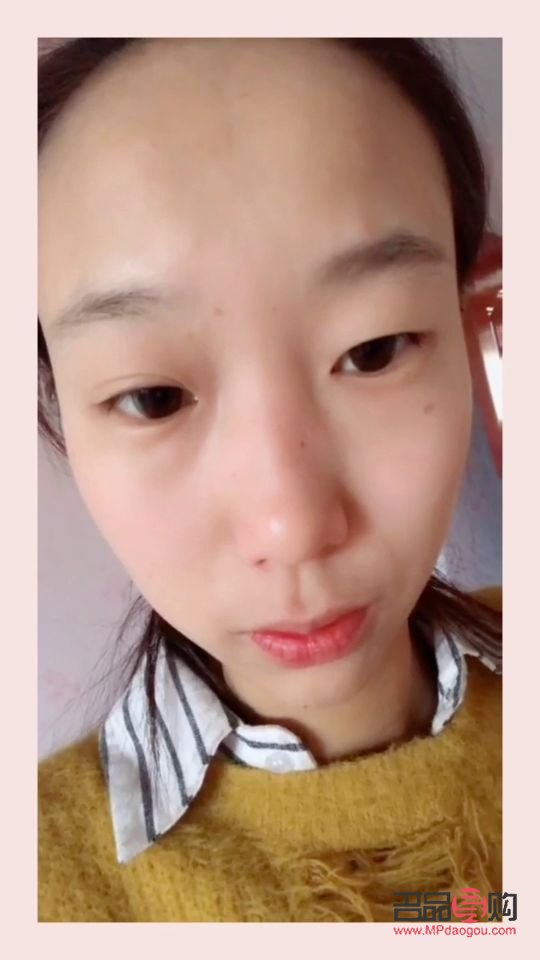 雙眼皮寬了怎么補救視頻(雙眼皮寬了怎么補救視頻教程)