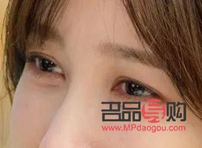 <h3>40歲眼皮松弛下垂：探尋最佳解決方案</h3>