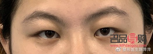 腫眼泡是怎么回事？