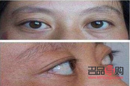 甲亢眼睛凸怎么改善(甲亢眼睛凸怎么治)