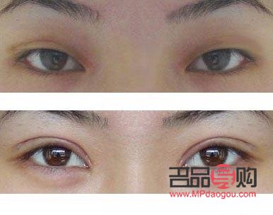 雙眼皮手術(shù)的后遺癥有哪些(雙眼皮手術(shù)的后遺癥有哪些癥狀)