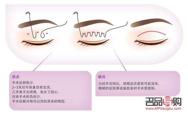 雙眼皮貼引起的過敏紅腫問題解析