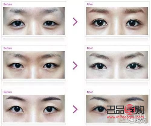 <h3>5G桃花眼雙眼皮手術(shù)風(fēng)險(xiǎn)解析</h3>