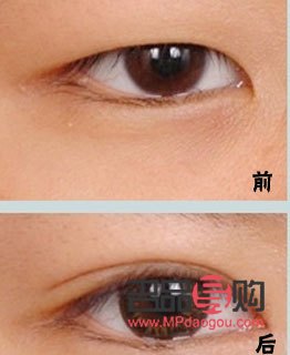 割雙眼皮最佳季節(jié)的選擇與考量