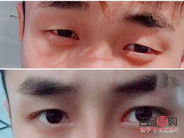 男生眼睛小怎么變大(男生眼睛小怎么變大不手術(shù))