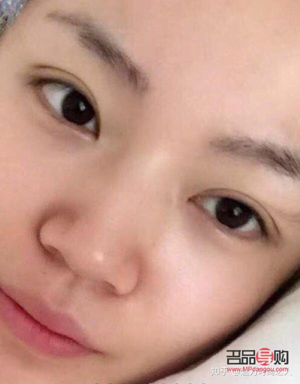 雙眼皮逆襲成功(雙眼皮逆襲成功率高嗎)