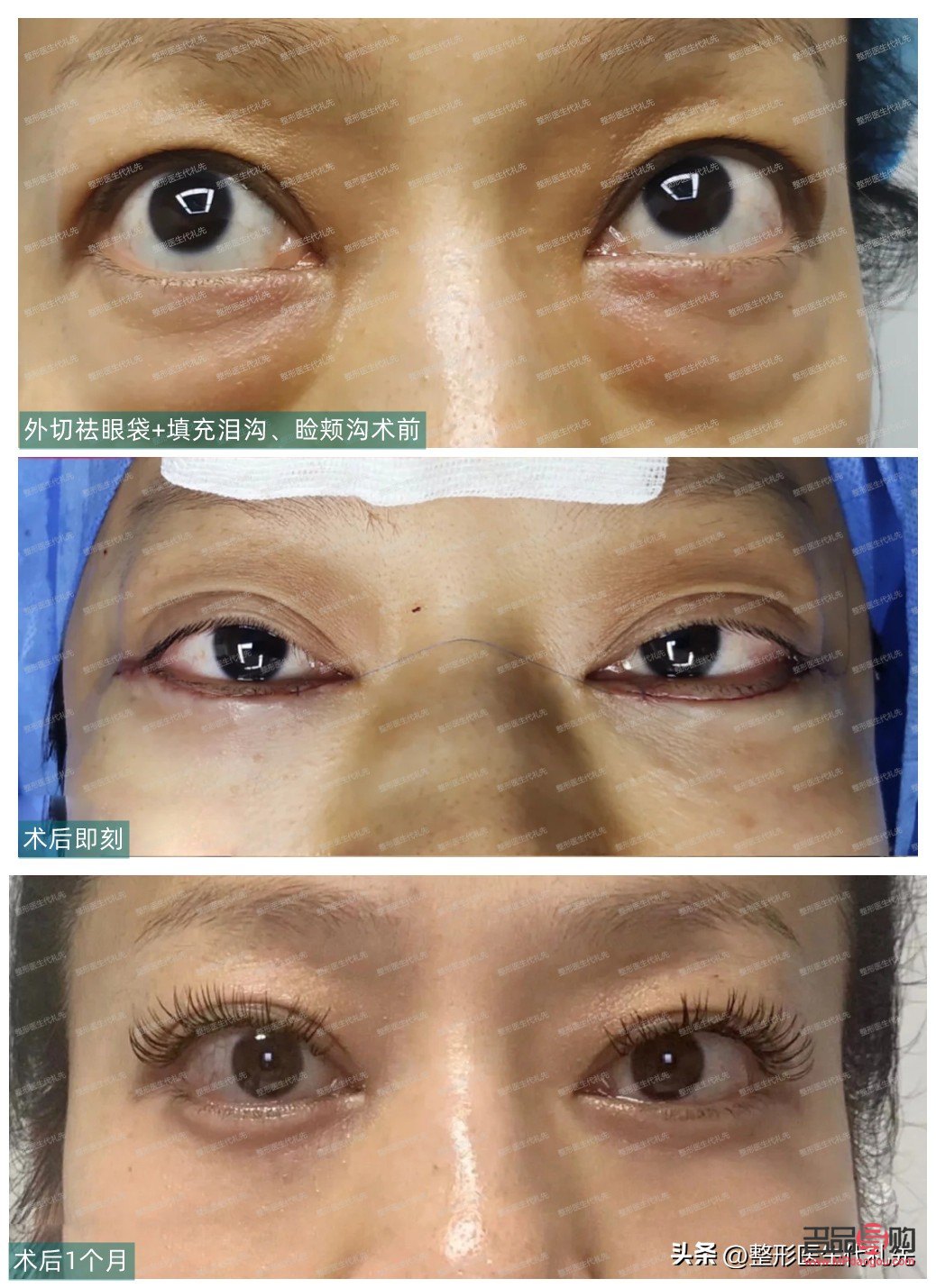 年齡大有眼袋如何辦(年齡大有眼袋如何辦消除)