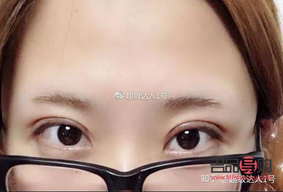 開扇雙眼皮手術全解析