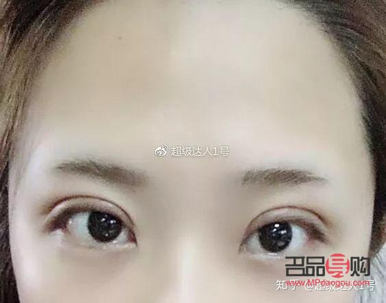 開扇雙眼皮手術全解析