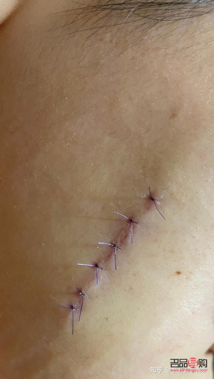 美容線怎么拆線(美容線怎么拆線示范)