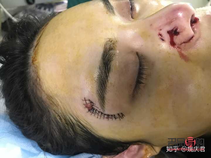 美容線怎么拆線(美容線怎么拆線示范)