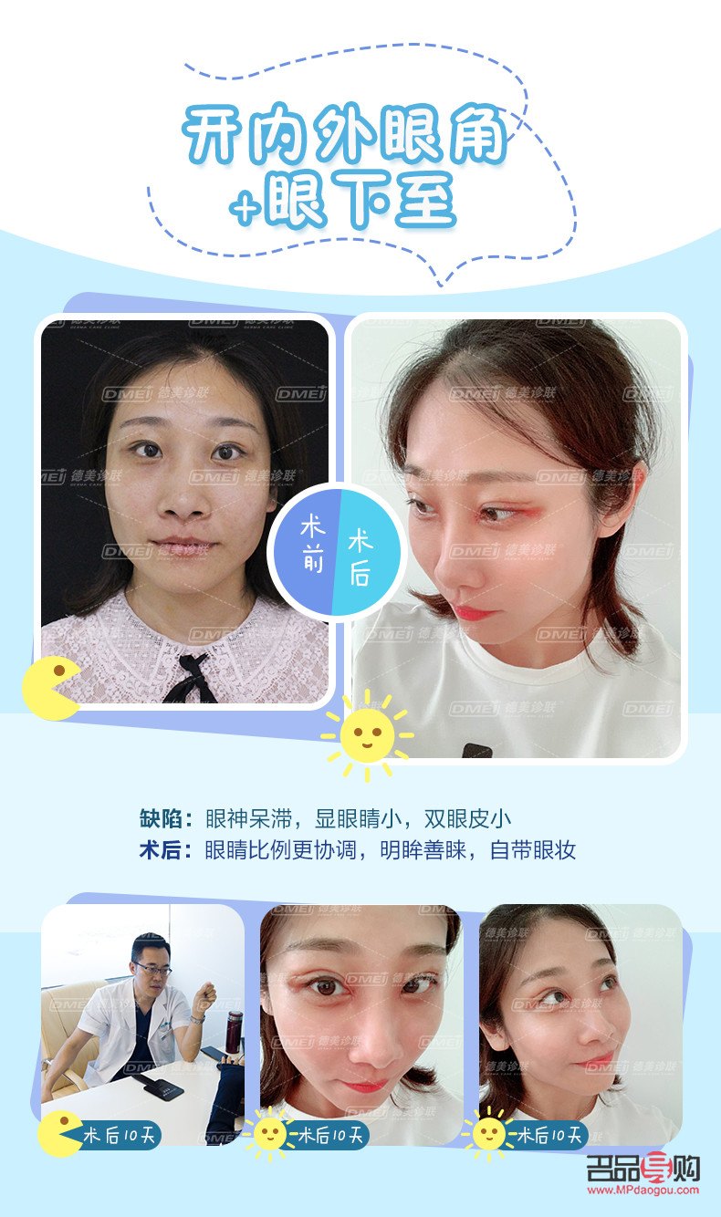 小眼睛開(kāi)眼角雙眼皮效果(小眼睛開(kāi)眼角雙眼皮效果好嗎)