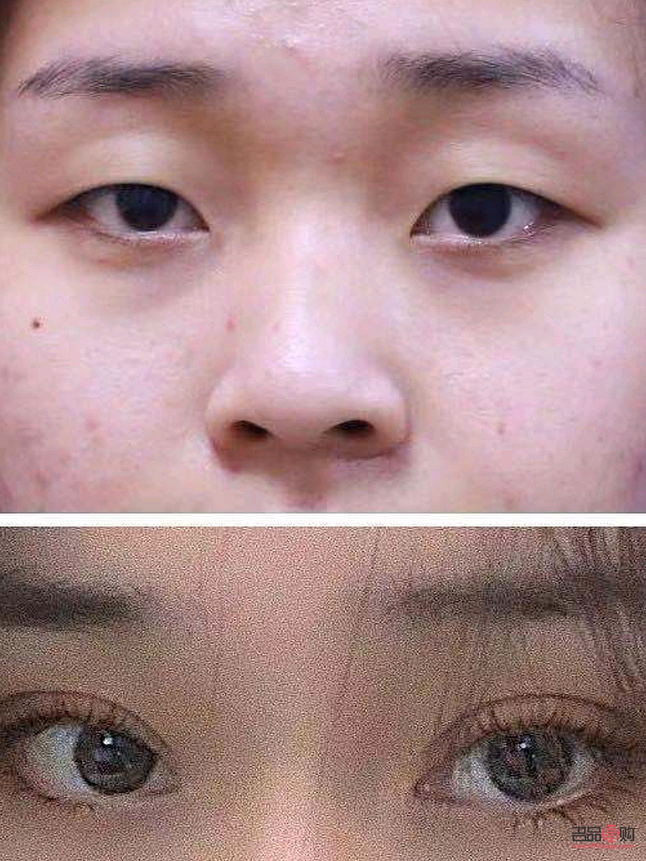 小眼睛開(kāi)眼角雙眼皮效果(小眼睛開(kāi)眼角雙眼皮效果好嗎)